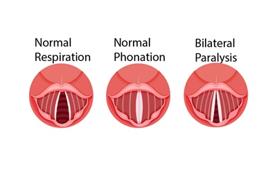 Illustration of bilateral paralysis